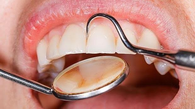 Confirmado: la periodontitis se asocia a un mayor riesgo de cáncer
