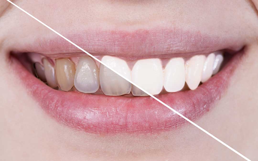Dientes con manchas blancas, amarillas y negras en niños: ¿cómo solucionarlo?