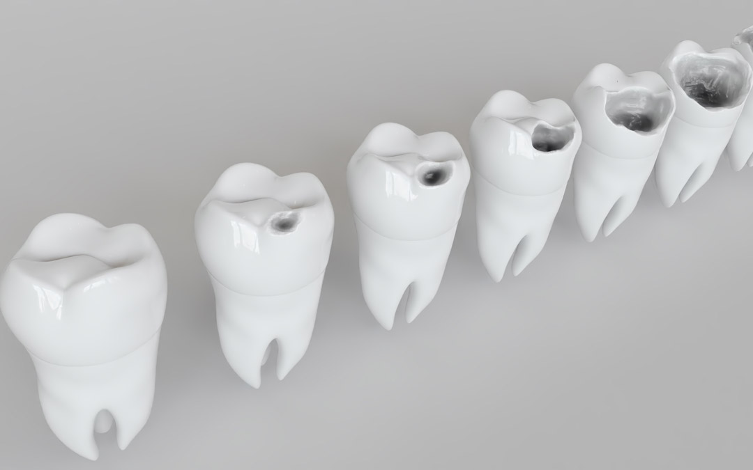 ¿Sabes que cuales son los síntomas de las cariés dentales?