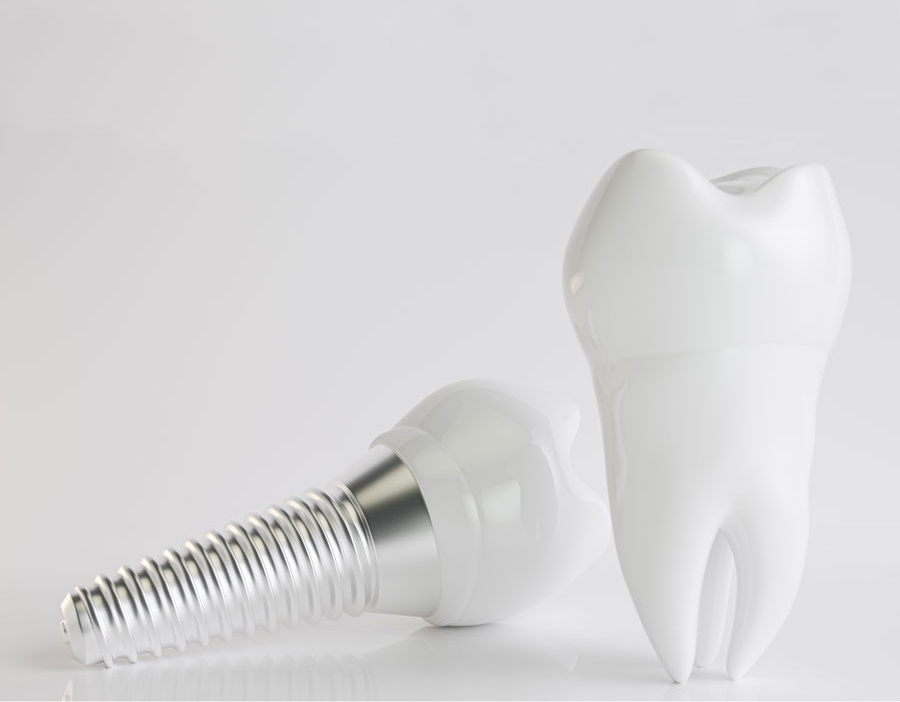 Implante dental al lado de diente