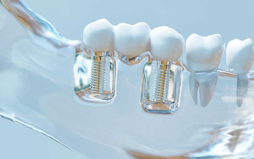 Lo que debes hacer para mantener tus implantes dentales cuidados