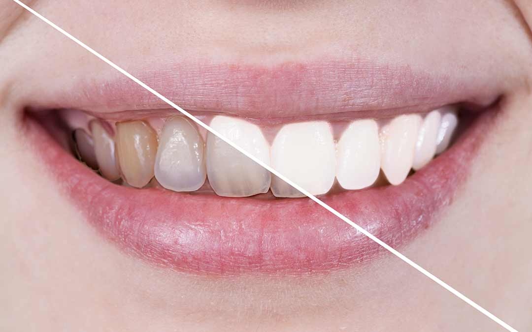 ¿Cuánto dura un blanqueamiento dental?