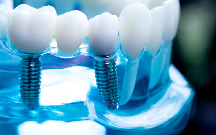 Agarrar Empuje Intenso Implantes dentales sin hueso: ¿Qué soluciones existen?