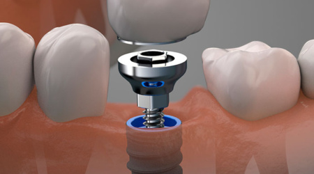 Partes de un implante dental separadas